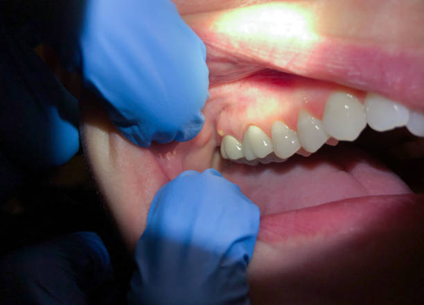 Best Chipped Tooth Repair Near Me  in Fort Salonga, NY